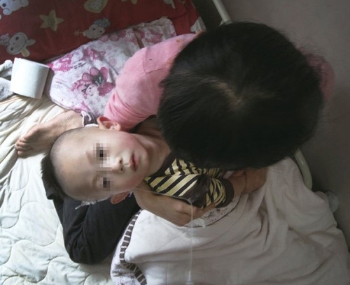 两岁儿童做疝气手术脑萎缩